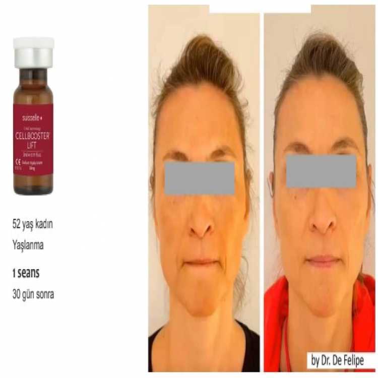 Kırışıklık Giderici Cell Booster Tedavisi | Uzman Dr. Demet Aşkın